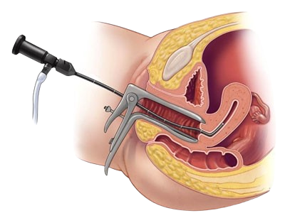 Laparoscopy & Hysteroscopy Treatment - SG Hospital